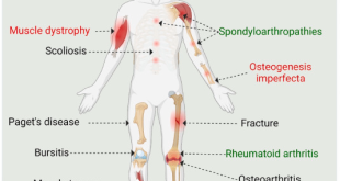 Musculoskeletal Disorders in human